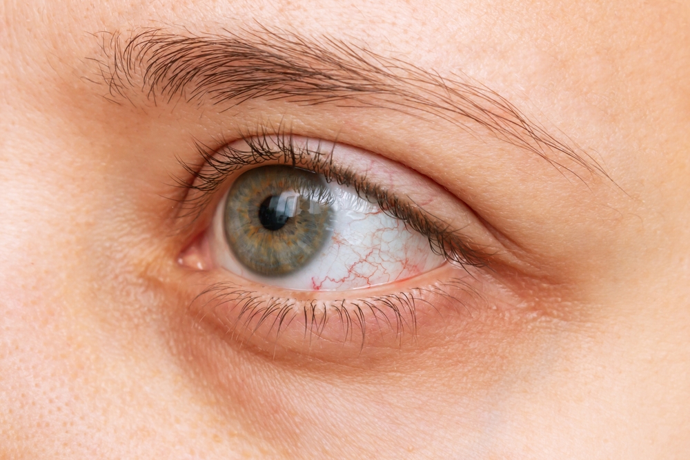 dry eye syndrome dry eye syndrome
